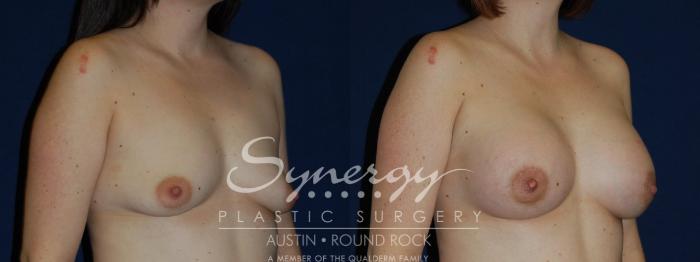 Before & After Breast Lift & Breast Augmentation Case 132 View #3 View in Austin, TX