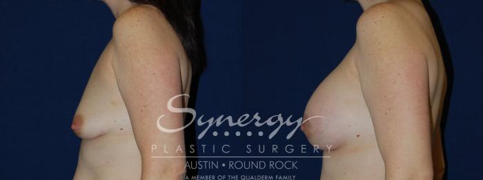Before & After Breast Lift & Breast Augmentation Case 132 View #4 View in Austin, TX