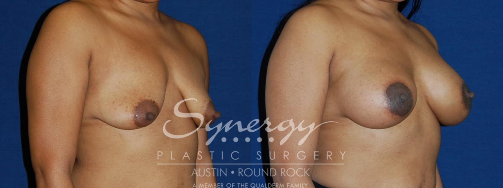 Before & After Breast Lift & Breast Augmentation Case 133 View #1 View in Austin, TX
