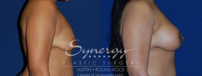 Before & After Breast Lift & Breast Augmentation Case 133 View #2 View in Austin, TX