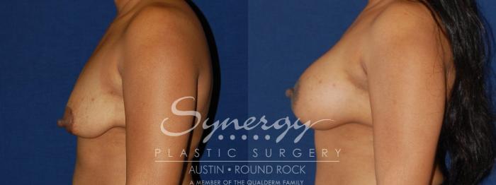 Before & After Breast Lift & Breast Augmentation Case 133 View #3 View in Austin, TX
