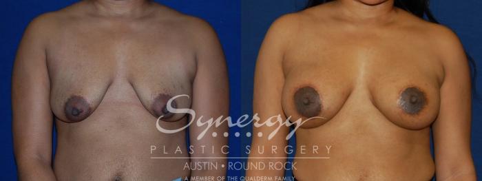 Before & After Breast Lift & Breast Augmentation Case 133 View #4 View in Austin, TX