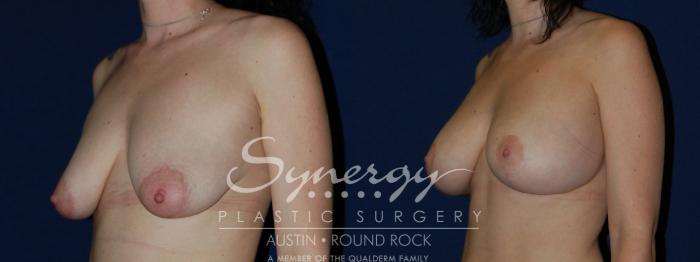 Before & After Breast Lift & Breast Augmentation Case 136 View #1 View in Austin, TX