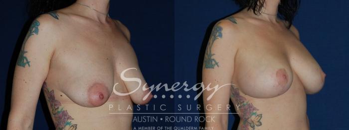 Before & After Breast Lift & Breast Augmentation Case 136 View #3 View in Austin, TX