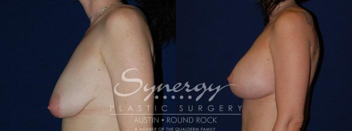 Before & After Breast Lift & Breast Augmentation Case 136 View #4 View in Austin, TX