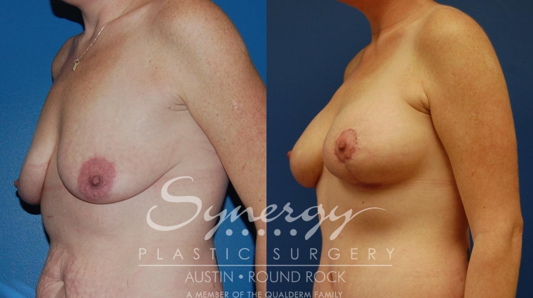 Before & After Breast Lift & Breast Augmentation Case 15 View #1 View in Austin, TX