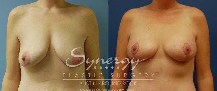 Before & After Breast Lift & Breast Augmentation Case 15 View #2 View in Austin, TX