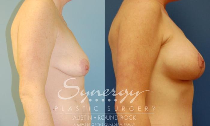 Before & After Breast Lift & Breast Augmentation Case 15 View #3 View in Austin, TX