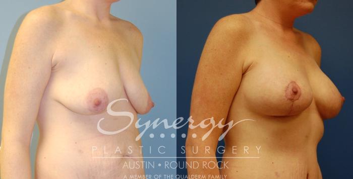 Before & After Breast Lift & Breast Augmentation Case 15 View #4 View in Austin, TX