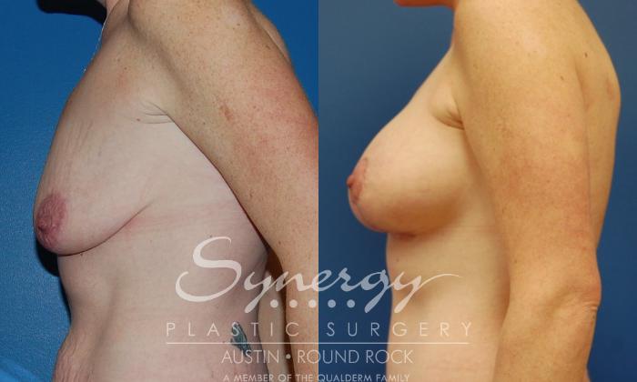 Before & After Breast Lift & Breast Augmentation Case 15 View #5 View in Austin, TX