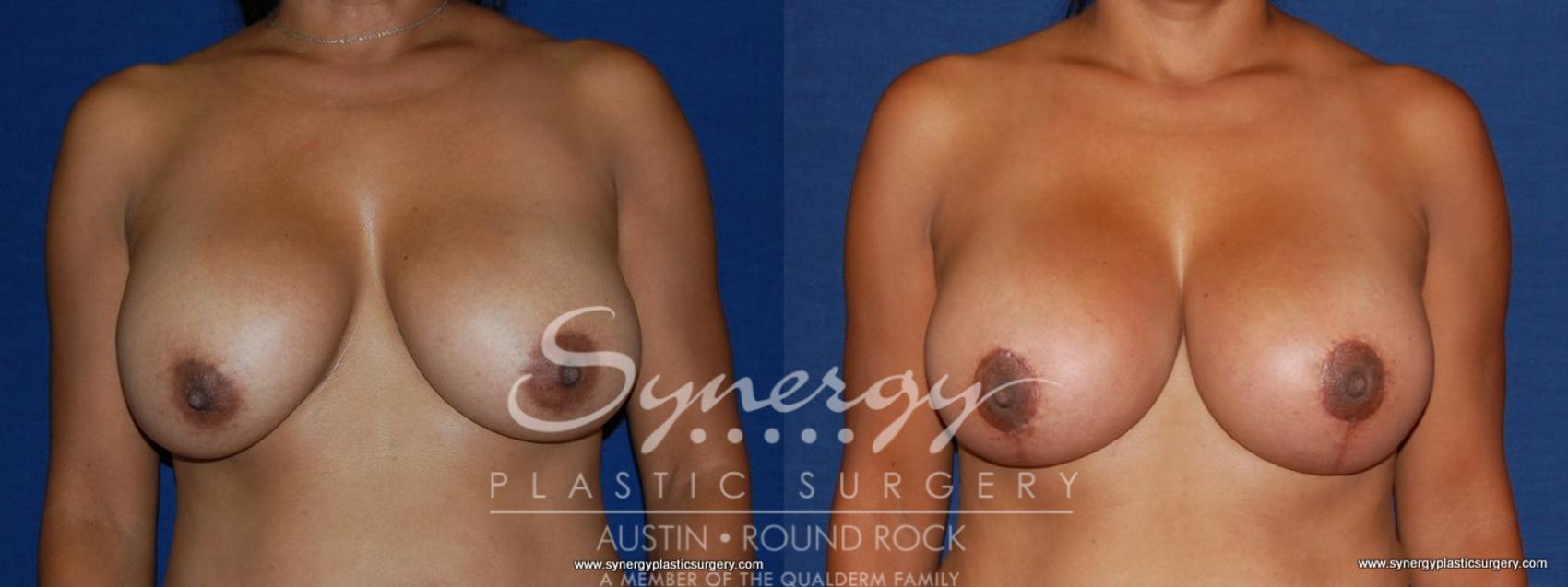 Before & After Breast Lift & Breast Augmentation Case 172 View #1 View in Austin, TX