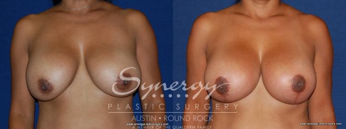 Before & After Breast Lift & Breast Augmentation Case 172 View #1 View in Austin, TX