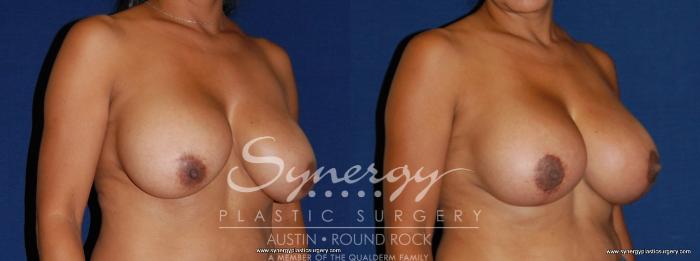 Before & After Breast Lift & Breast Augmentation Case 172 View #2 View in Austin, TX