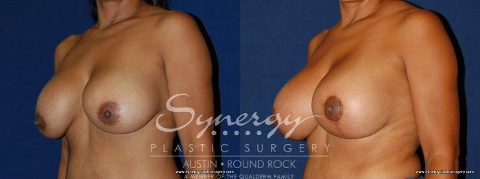 Before & After Breast Lift & Breast Augmentation Case 172 View #3 View in Austin, TX