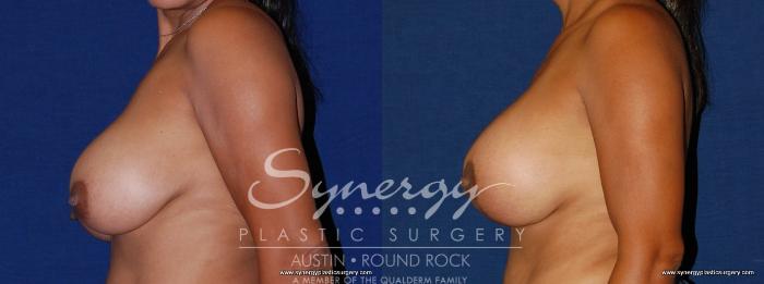 Before & After Breast Lift & Breast Augmentation Case 172 View #4 View in Austin, TX