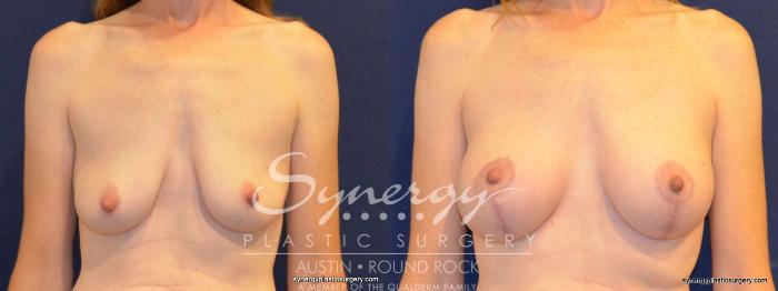 Before & After Breast Lift & Breast Augmentation Case 266 View #1 View in Austin, TX