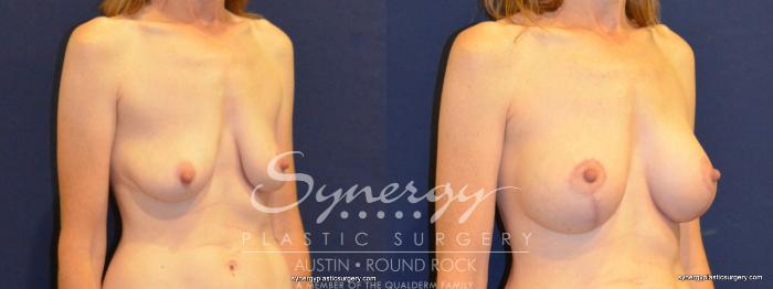 Before & After Breast Lift & Breast Augmentation Case 266 View #2 View in Austin, TX
