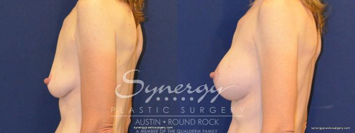 Before & After Breast Lift & Breast Augmentation Case 266 View #3 View in Austin, TX