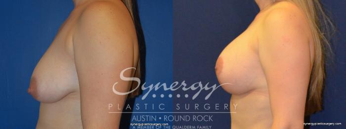 Before & After Breast Lift & Breast Augmentation Case 274 View #2 View in Austin, TX
