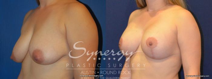 Before & After Breast Lift & Breast Augmentation Case 274 View #3 View in Austin, TX