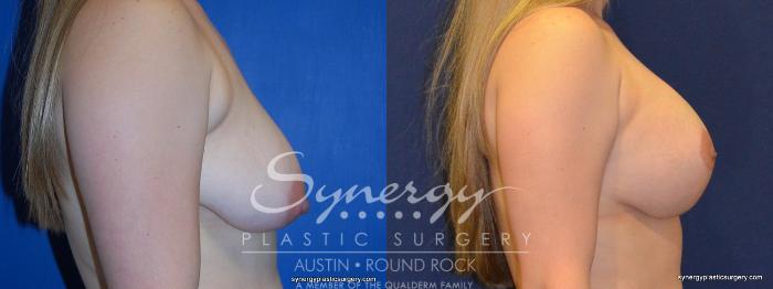 Before & After Breast Lift & Breast Augmentation Case 274 View #4 View in Austin, TX