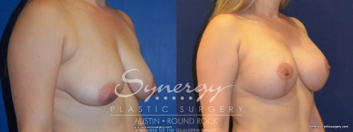 Before & After Breast Lift & Breast Augmentation Case 274 View #5 View in Austin, TX