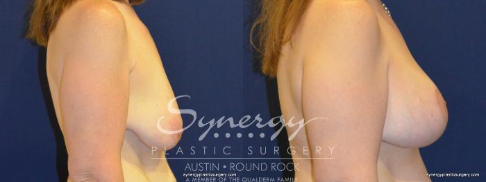 Before & After Breast Lift & Breast Augmentation Case 280 View #2 View in Austin, TX