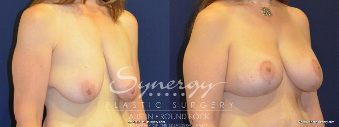 Before & After Breast Lift & Breast Augmentation Case 280 View #3 View in Austin, TX