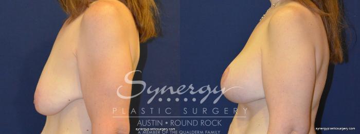 Before & After Breast Lift & Breast Augmentation Case 280 View #4 View in Austin, TX