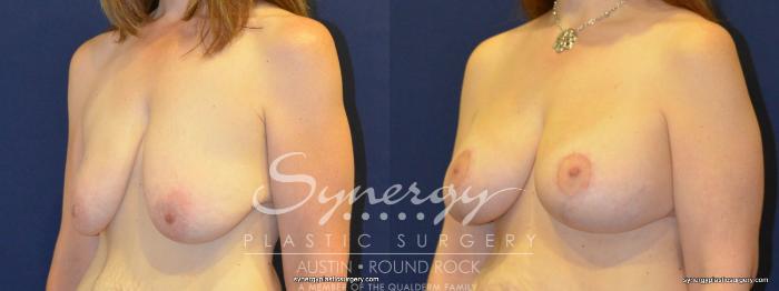 Before & After Breast Lift & Breast Augmentation Case 280 View #5 View in Austin, TX