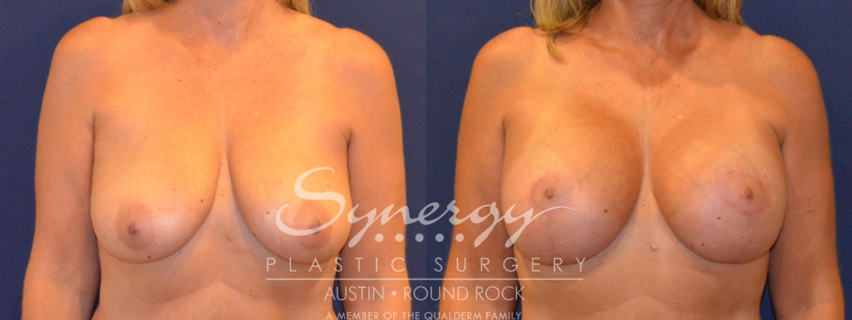 Before & After Breast Lift & Breast Augmentation Case 294 View #1 View in Austin, TX