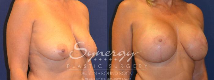 Before & After Breast Lift & Breast Augmentation Case 294 View #3 View in Austin, TX