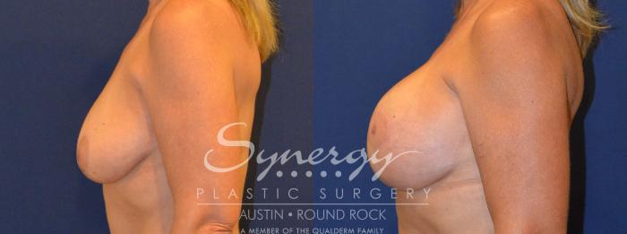 Before & After Breast Lift & Breast Augmentation Case 294 View #4 View in Austin, TX