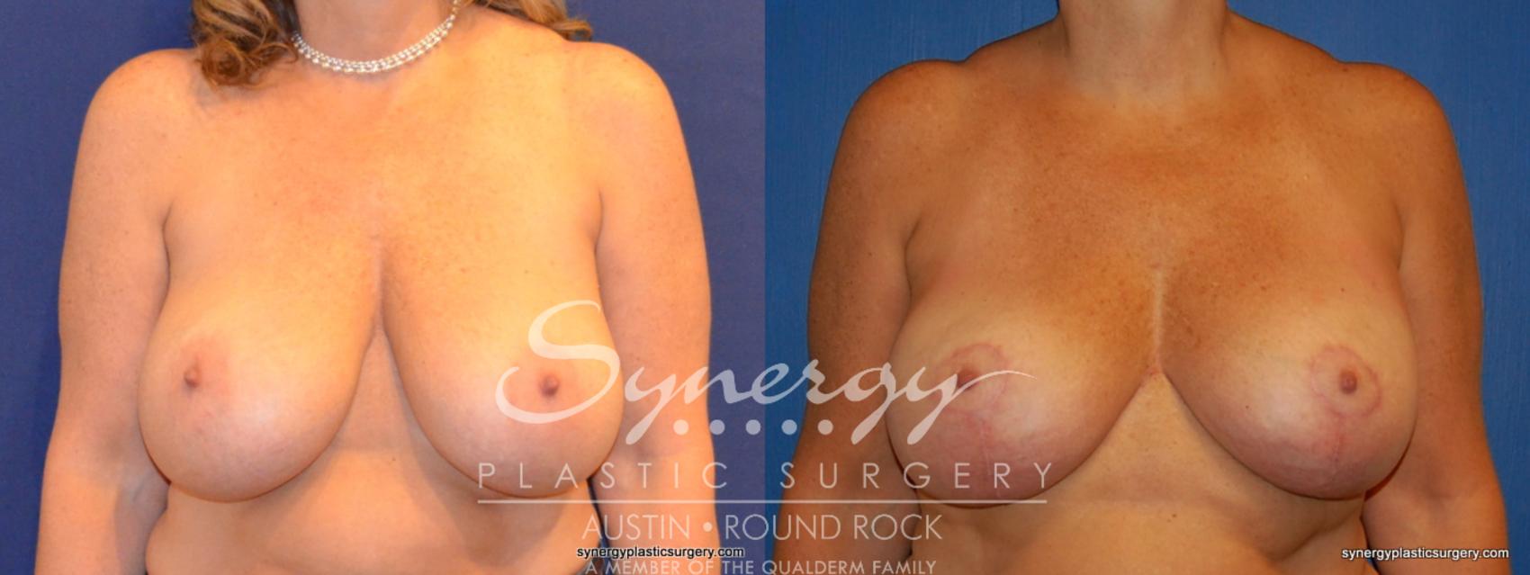 Before & After Breast Lift & Breast Augmentation Case 310 View #1 View in Austin, TX