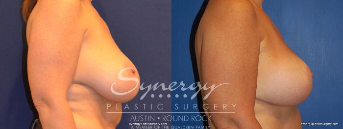 Before & After Breast Lift & Breast Augmentation Case 310 View #2 View in Austin, TX
