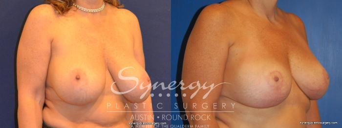 Before & After Breast Lift & Breast Augmentation Case 310 View #3 View in Austin, TX