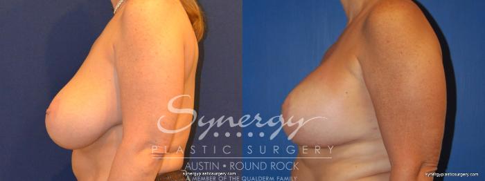 Before & After Breast Lift & Breast Augmentation Case 310 View #4 View in Austin, TX