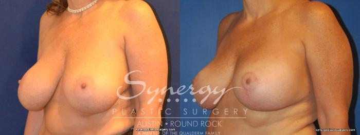 Before & After Breast Lift & Breast Augmentation Case 310 View #5 View in Austin, TX