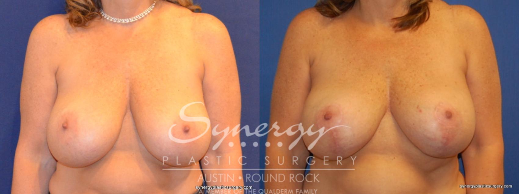 Before & After Breast Lift & Breast Augmentation Case 378 View #1 View in Austin, TX