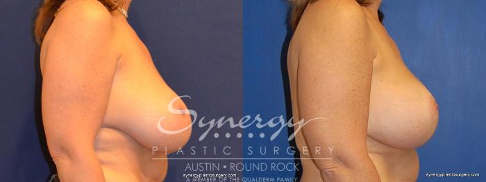 Before & After Breast Lift & Breast Augmentation Case 378 View #2 View in Austin, TX