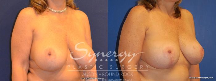 Before & After Breast Lift & Breast Augmentation Case 378 View #3 View in Austin, TX