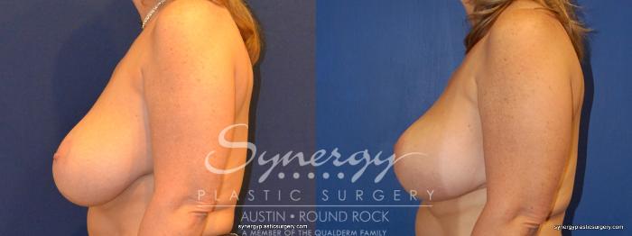 Before & After Breast Lift & Breast Augmentation Case 378 View #4 View in Austin, TX