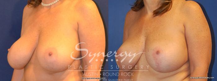 Before & After Breast Lift & Breast Augmentation Case 378 View #5 View in Austin, TX