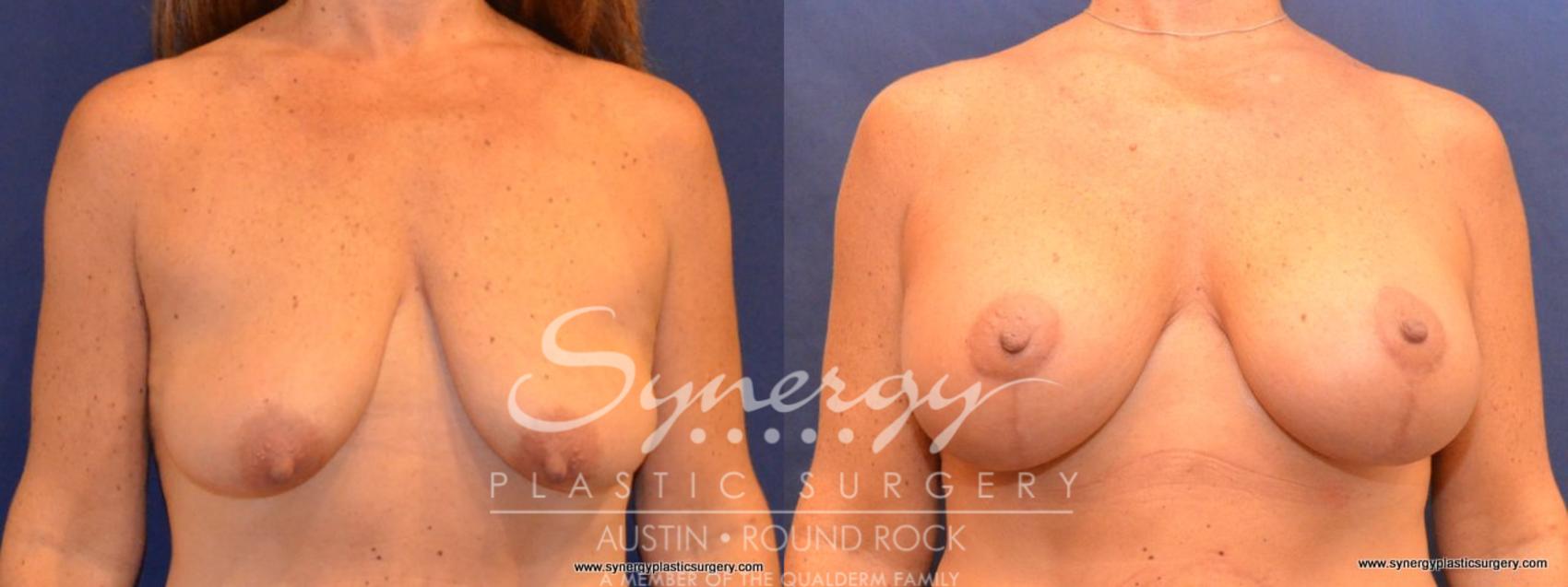 Before & After Breast Lift & Breast Augmentation Case 419 View #1 View in Austin, TX
