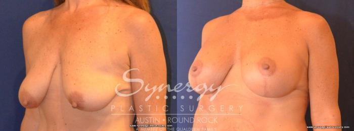 Before & After Breast Lift & Breast Augmentation Case 419 View #4 View in Austin, TX