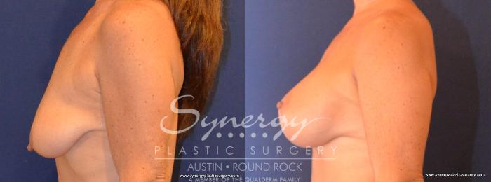 Before & After Breast Lift & Breast Augmentation Case 419 View #5 View in Austin, TX