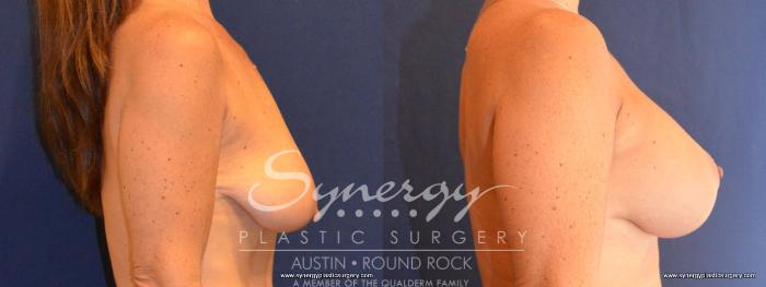 Before & After Breast Lift & Breast Augmentation Case 419 View #6 View in Austin, TX