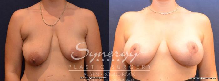 Before & After Breast Lift & Breast Augmentation Case 433 View #1 View in Austin, TX