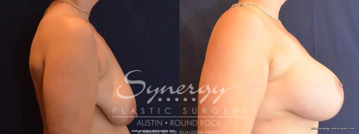 Before & After Breast Lift & Breast Augmentation Case 433 View #2 View in Austin, TX