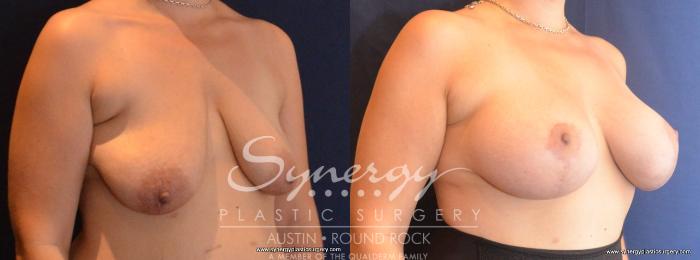 Before & After Breast Lift & Breast Augmentation Case 433 View #3 View in Austin, TX